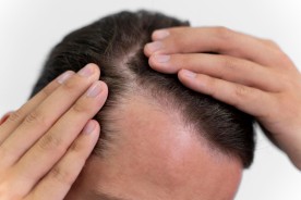 alopecie barbat